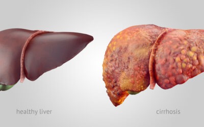 Esteatose Hépatica – a famosa gordura no fígado